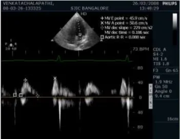 Figure 1: E, A, IVRT and deceleration time was  derived from pulse-wave doppler recordings of the 