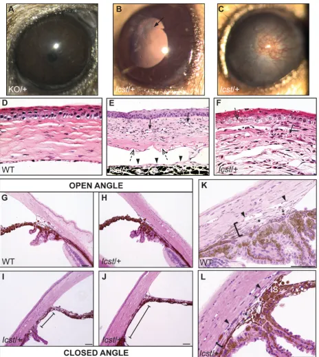Figure 2. Icstvascularisation and central opacity. (D–F). Histological appearance of corneas