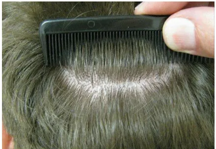 Figure 3 Post-operative result of a healed trichophytic closure.
