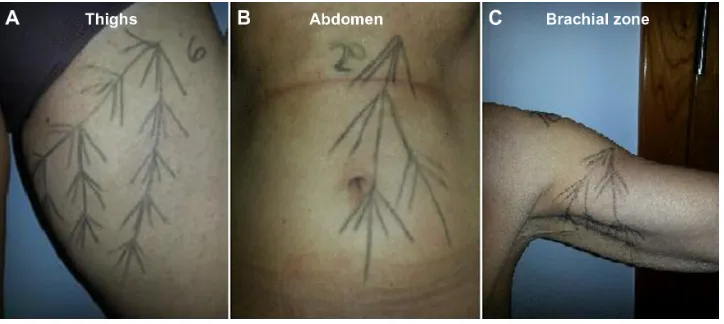 Figure 1 examples of a vector map for injection in (A) thighs, (B) abdomen, and (C) brachial zones.