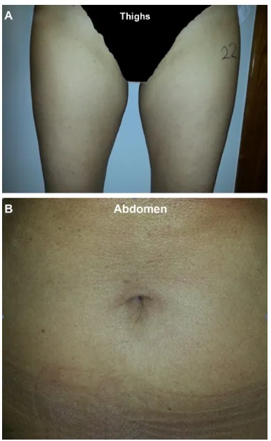 Figure 3 Proportions of skin density and thickness scores that showed an improvement 5 weeks after treatment relative to baseline.