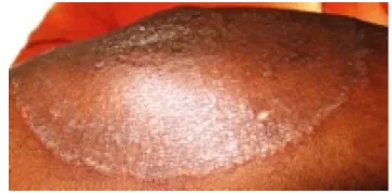 Figure 13 Tinea corporis (right knee).Note: Extensive scaly lesion with no central clearing.