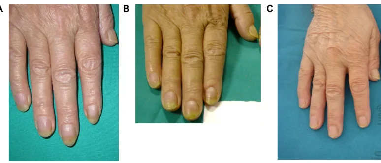 Figure 7 nail plate crumbling, hyperkeratosis, and splinter hemorrhage improved after 24 weeks and resolved after 27 months compared to baseline.Notes: (A) Baseline; (B) improvement after 24 weeks; (C) resolved after 27 months.
