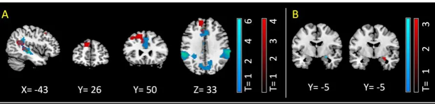 Figure 1. Interaction of ATB and visual-emotional stimulation on brain activation in cingulate 