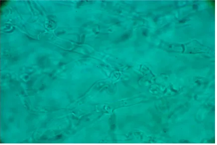 Figure 2 Trichophyton violaceum (lactophenol cotton blue mount).Notes: Tangled hyphae, branched and irregular