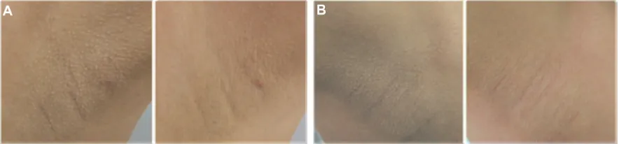 Figure 3 Photographs showing an excellent clinical response to treatment. (A) Axillae in a 22-year-old woman treated with niacinamide (left image)