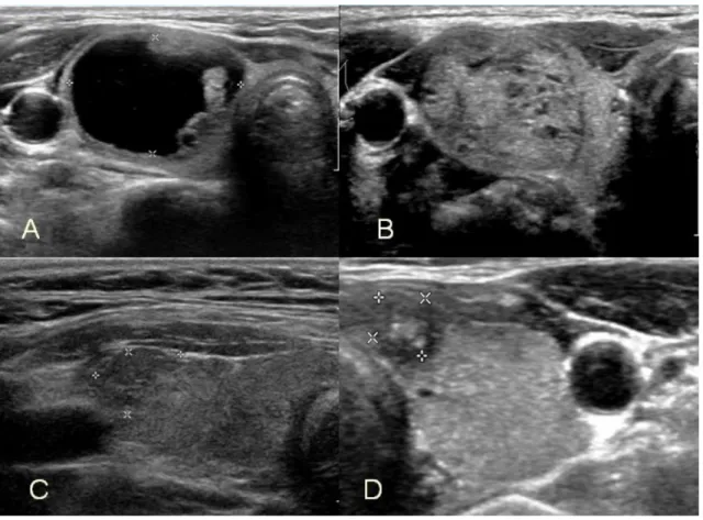 Fig 1. A) A solid cystic nodule (TIRADS 2), B) A well-defined solid nodule with microcalcification (TIRADS 3), C) An ill-defined nodule  (TIRADS 4), D) An ill-defined nodule with outgrowth margin at superior border with internal microcalcification (TIRADS 