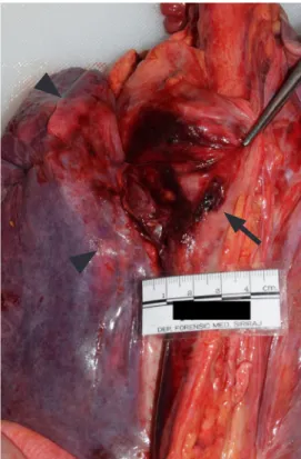Fig 1.  Aortic aneurysm located at the isthmus (arrow), with compressed 