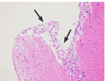 Fig 3. Granulation tissue at the rupture site of the aorta (arrow),  H&amp;E staining.