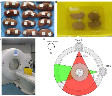 Figure 1. Study Design All human urinary stones were embedded into fresh porcine kidneys (A) and then the kidneys were placed in a 20-cm-deep water phantom (B)