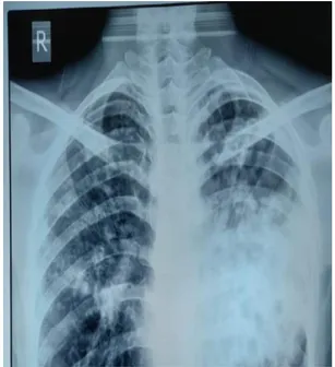 Figure 1: Chest x-ray of the patient with left middle  and lower zone consolidation. 