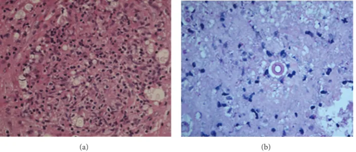 Figure 2: (a) Brain biopsy taken in December 2005, 4 months after initial presentation showing reactive gliosis and focally distendedperivascular spaces containing Cryptococcus