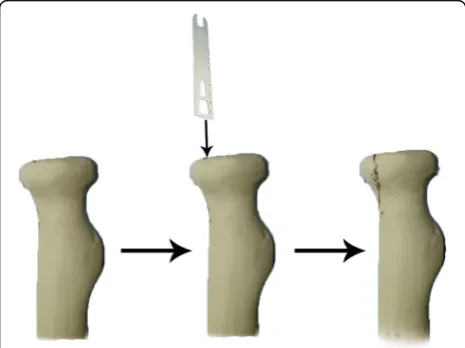 Fig. 1 The production process of Mason II radial head fractures