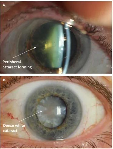 Figure 1.8: Micrographs demonstrating age related cataracts in patients whose pupils have been dilated