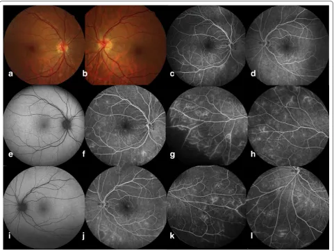 Fig. 2 Baseline and follow up fundus and fluorescein angiogram of a microalbuminuric Type 1 DM patient