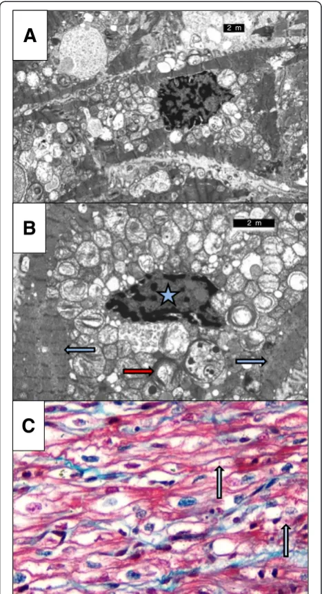 Figure 1 Abnormal Mitochondrial Appearance in BTHS DilatedCardiomyopathy. (A) Electron micrograph of cardiac muscle biopsyfrom a patient with severe BTHS DCM