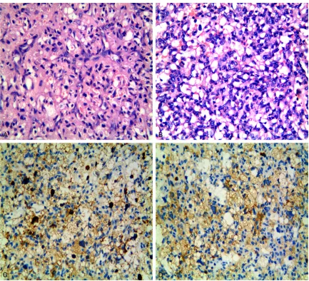 Figure 1. Histological and immunohistochemical features of the tumor from the patient described in case 1