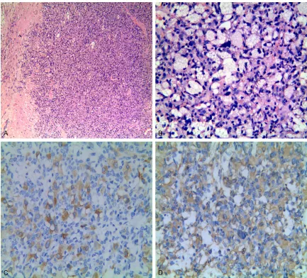 Figure 3. Histological and immunohistochemical features of the tumor from the patient described in case 3