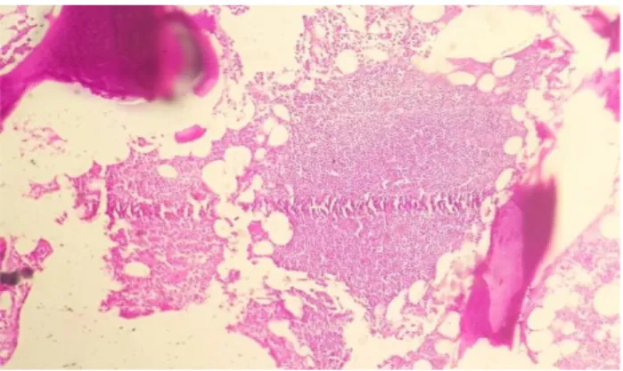 Figure 6: Bone marrow biopsy sections showing  metastatic deposits of adenocarcinoma. 
