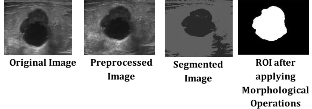 Figure 2. BUS image- Preprocessed by MAVM filter and segmented  by ReKM clustering with λ as 0.007 