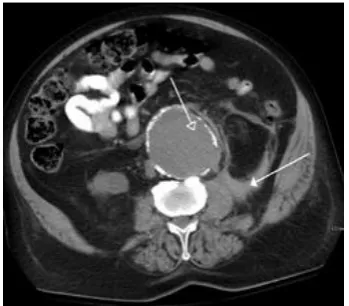Fig 1: A CT scan image showing a ruptured abdominal aortic aneurysm.  