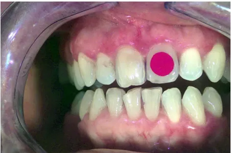 Figure 4. A patient, showing gingival colour change, imaged on two occasions with a 