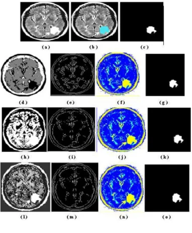 Fig. 7: Image segmentation of the third brain MR image of size (165175) - (a)  Original image; (b) and (c) are ground truth and ground truth tumor images respectively; (d), (e), (f) and (g) are images with segmentation, boundary, label and tumor segmentation respectively of K- means method; (h), (i), (j) and (k) are images with segmentation, boundary, label and tumor segmentation respectively of Expectation Maximization method; (l), (m), (n) and (o) are images with  segmentation, boundary, label and tumor segmentation respectively of Fuzzy C-means algorithm 