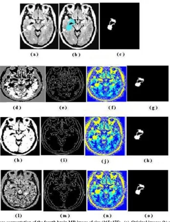Fig. 8:  Image segmentation of the fourth brain MR image of size (165175) - (a)  Original image; (b) and (c) are ground truth and ground truth tumor images respectively; (d), (e), (f) and (g) are images with segmentation, boundary, label and tumor segmentation respectively of K- means method; (h), (i), (j) and (k) are images with segmentation, boundary, label and tumor segmentation respectively of Expectation Maximization method; (l), (m), (n) and (o) are images with  segmentation, boundary, label and tumor segmentation respectively of Fuzzy C-means algorithm 