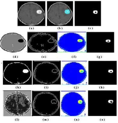 Fig. 9:  Image segmentation of the fifth brain MR image of size (165175) - (a)  Original image; (b) and (c) are ground truth and ground truth tumor images respectively; (d), (e), (f) and (g) are images with segmentation, boundary, label and tumor segmentation respectively of K- means method; (h), (i), (j) and (k) are images with segmentation, boundary, label and tumor segmentation respectively of Expectation Maximization method; (l), (m), (n) and (o) are images with  segmentation, boundary, label and tumor segmentation respectively of Fuzzy C-means algorithm  