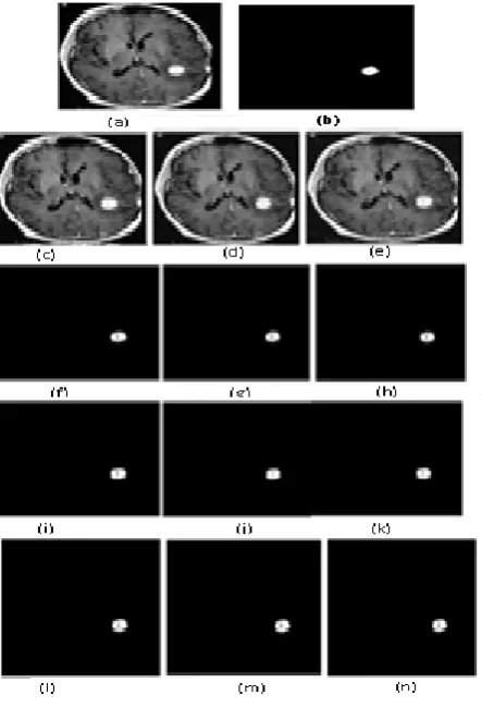 Figure. 1 Image segmentation of  brain MR image of size (165175)-(a) original image and  (b) ground truth tumor image, (c), (d) and (e) Gaussian noise images with 3, 5 and 7% respectively; (f), (g) and (h) corresponding segmented tumor images using k-means method respectively; (i), (j) and (k) corresponding segmented tumor images using 