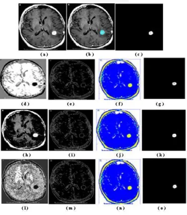 Fig. 5: Image segmentation of the first brain MR image of size (165175) - (a)  Original image; (b) and (c) are ground truth and ground truth tumor images respectively; (d), (e), (f) and (g) are images with segmentation, boundary, label and tumor segmentation respectively of K- means method; (h), (i), (j) and (k) are images with segmentation, boundary, label and tumor segmentation respectively of Expectation Maximization method; (l), (m), (n) and (o) are images with  segmentation, boundary, label and tumor segmentation respectively of Fuzzy C-means algorithm 