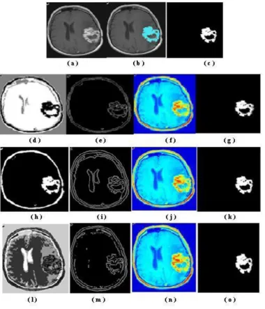 Fig. 6: Image segmentation of the second brain MR image of size (165175) - (a)  Original image; (b) and (c) are ground truth and ground truth tumor images respectively; (d), (e), (f) and (g) are images with segmentation, boundary, label and tumor segmentation respectively of K- means method; (h), (i), (j) and (k) are images with segmentation, boundary, label and tumor segmentation respectively of Expectation Maximization method; (l), (m), (n) and (o) are images with  segmentation, boundary, label and tumor segmentation respectively of Fuzzy C-means algorithm  