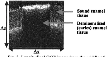 Fig. 3. Longitudinal OCT image from the middle ofthe transversal image in figure 2 showing a caries