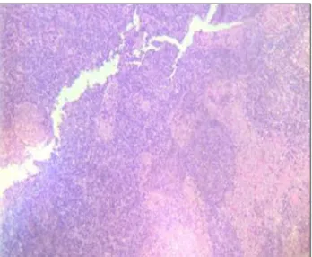 Figure 9: Lymphocytes of varying sizes and  transformed lymphocytes, numerous tangible body  macrophages, few foamy macrophages and crescentic 