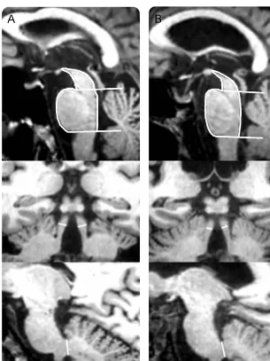 Figure 1MRI measurements in patients with progressive supranuclear palsy–