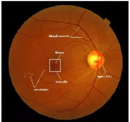Figure 1. Color retina fundus image of stage 2 DME withlesions and anatomical structures are marked
