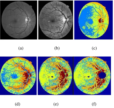 Figure 2. Exudates Segmentation: Original green channelimage, (b) preprocessed green channel image (c) basicPSO, (d) feature based PSO, (e) Combined PSO –FCMfeature based, (f) results after OD removal