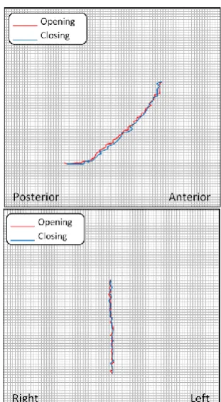 Fig 13: Coronal (frontal) and Sagittal (lateral) views of jaw movement for a subject suffering from Anterior Disc dislocation without reduction in the left tempro-mandibular joint (The Shift begins to occur at approximately 20 mm) note the marked limiting 