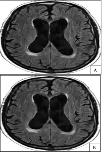 Figure 4: FLAIR images in a 62-year patient with  NPH shows bilateral lateral ventricular dilatation  with hyper intensity around frontal and peritrigonal 