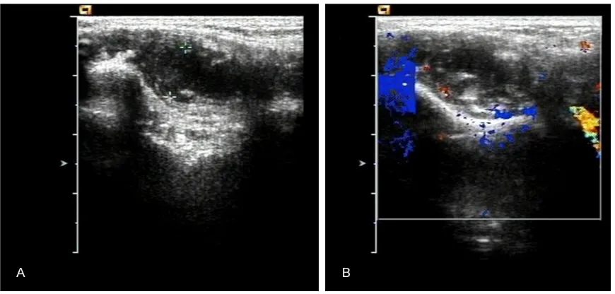 Figure 1. A: Synovial thickening in the ankle; B: Abnormal PD signal in the ankle.
