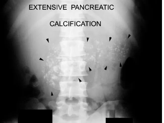 Figure 1.6 Chronic Pancreatitis demonstrated on plain abdominal radiograph showing 