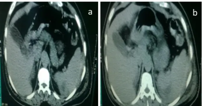 Figure 1: CT section of spleen in BAT patient.  The patients with hemoperitoneum or abdominal visceral  injury  or  both  were  considered  as  positive