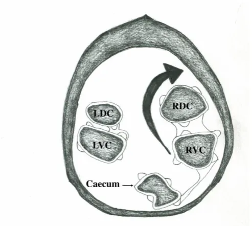 Figure 5:  A schematic diagram representing the more common dorso-medial direction of a 