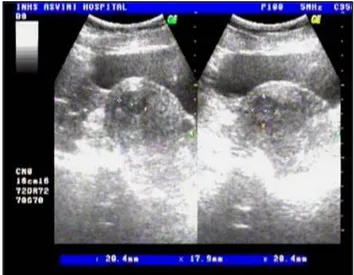 Figure 5: Ultrasound image of dominant fibroid prior  to embolisation. The maximum cross-sectional 