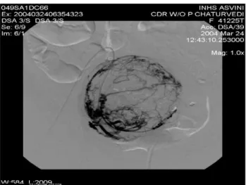 Figure 12: Postembolisation right uterine arteriogram  demonstrating absent flow to the fibroid mass