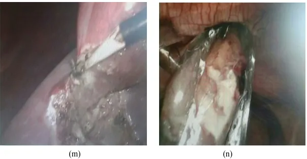 Figure 2. (a) The anterior wall of gall bladder was incised just above the Hartmann pouch by laparoscopic scissor, and after dissection of adhesion around it; (b) Suction of the gall bladder contents, and big stones impacted at the Hartmann pouch and cysti
