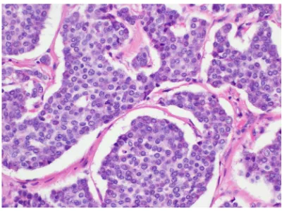 Figure 3. H & E staining of resected appendix show-ing normal mucosa on the left and neuroendocrine tumor on the right side invading deep in the underly-ing layer (Magnification 10X)