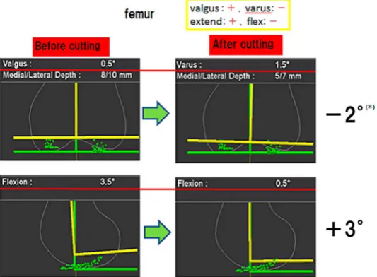Figure 2. Method of error evaluation on the femur and tibia. (a) On the femur Error of valgus position as + and varus posi-tion as − in the coronal plane (upper side)
