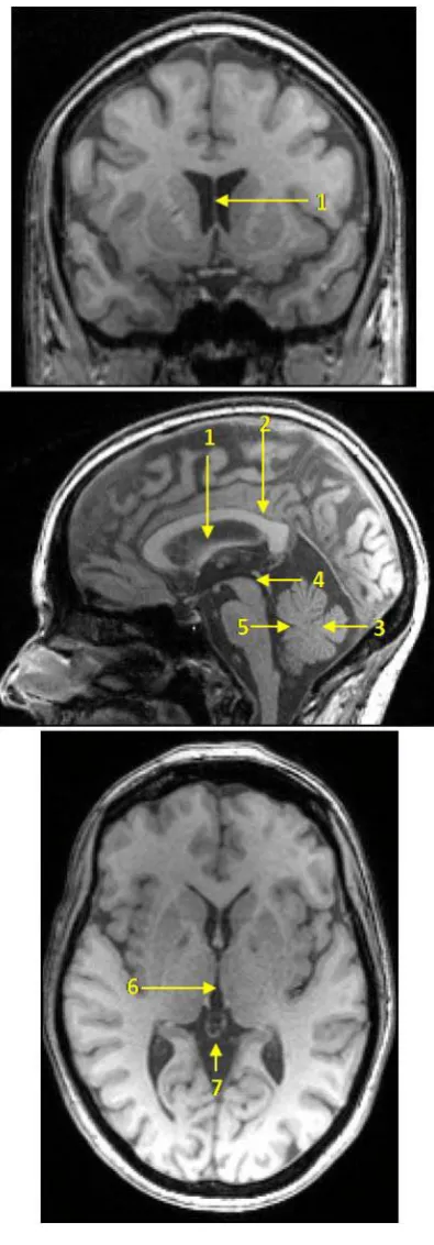Fig. 3.5. Criteria for selecting the midsagittal slice. Top, coronal view; middle, sagittal 