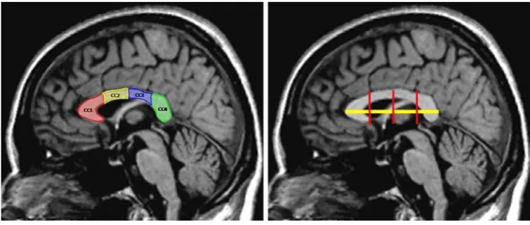 Fig. 3.6. Method of subdividing the CC on midsagittal T1-weighted MR image. Right, 